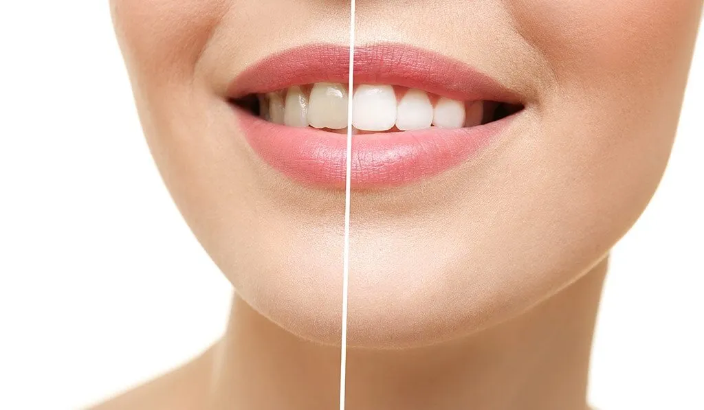 Un sorriso prima e dopo il trattamento smacchiante